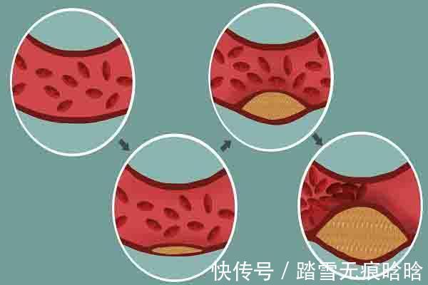 胆固醇|高血脂的“大冤家”被发现了，这1物早晚敞开肚子吃