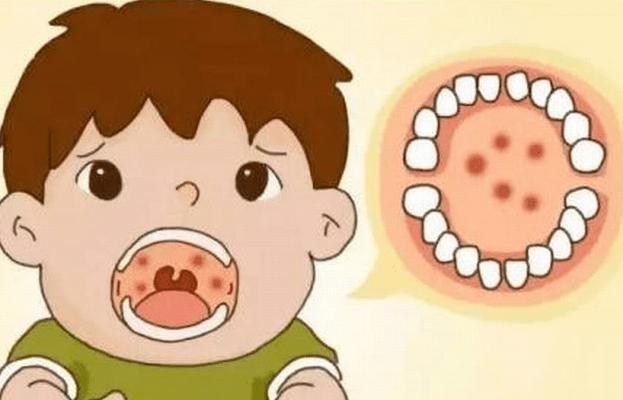 特效药|这个夏季传染病,6岁以下儿童常中招,七个问题全面了解