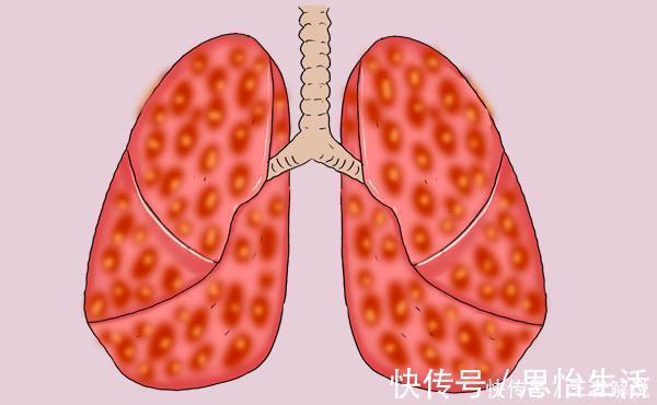 手术|肺癌患者术后复发,还可以再次手术吗?别着急,综合评定后再决定