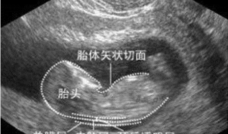 小美|不想生个“傻儿子”,孕期有三项检查不可少,准妈咪别不当回事