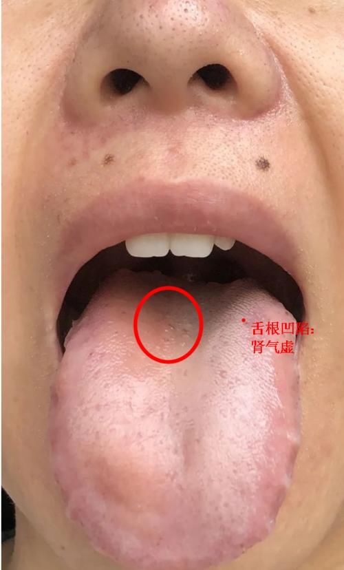 六味地黄丸|想要补肾?分不清是肾阴虚,肾阳虚,还是肾精虚?教你一招区分