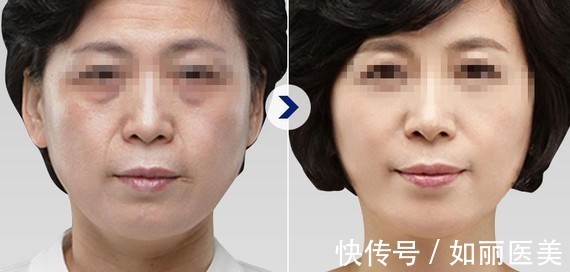 超声提升 热玛吉&超声提升,谁是抗衰NO.1?抗衰选它就对了!