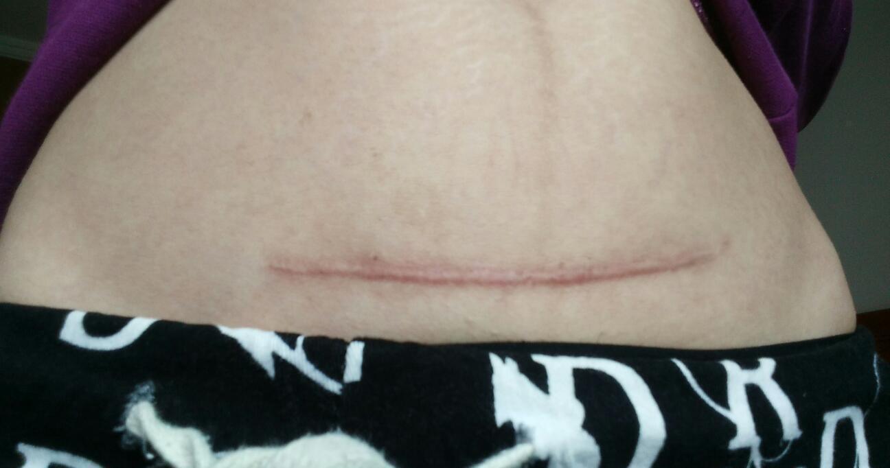 分娩|“横剖”与“竖剖”,哪个对二胎、三胎影响更大?这个选择很重要