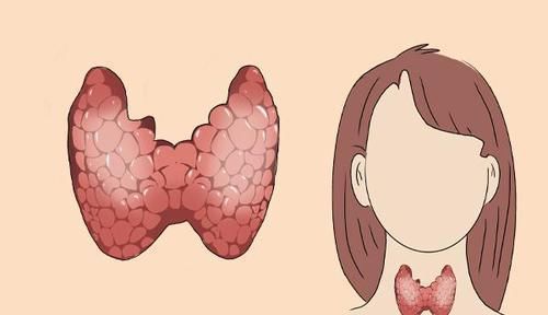 脖子出现一个变化时,别认为是大脖子病了医生需警惕1种癌症