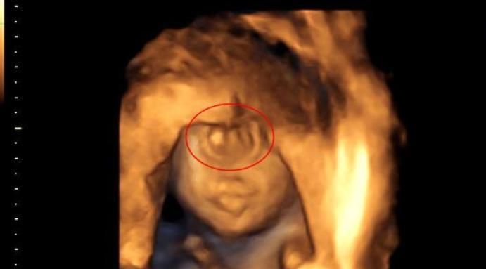 孩子|有多少孩子是产检没问题,出生才发现的?这3种情况孕检查不出