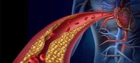 软化血管骗了囯人30年，什么木耳、洋葱，都是胡扯，早知早受益
