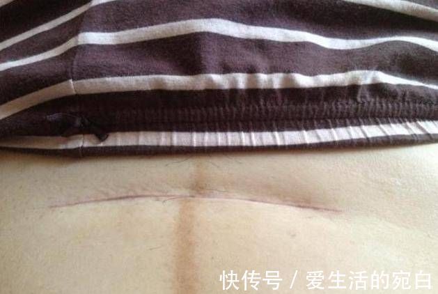 是真的吗|头胎剖腹产,第二胎继续剖,到底有多痛这些有经验的宝妈这样说