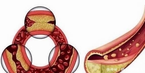 心脑血管|大蒜与它一起吃,胜过“他汀药”,经常吃点,高血脂不攻自破