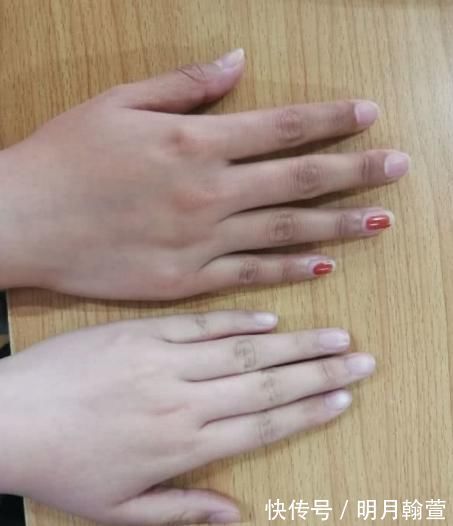 预防血栓|身体有“血栓”,手脚会告知!一旦手脚出现3种异常,抓紧防血栓