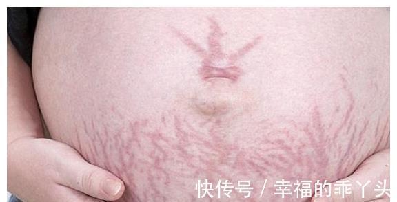 女性|为何同样都是怀孕,有些女性却不会长“妊娠纹”?孕妈要了解