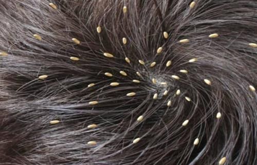 头皮屑|头发爱出油又懒的洗,洗头多加1步,7天不洗都不油不痒,超实用!