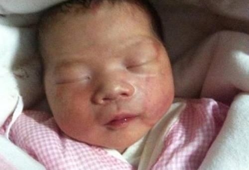 医生|6个月宝宝产钳印明显，奶奶找医生“算账”，医生的话让她脸红