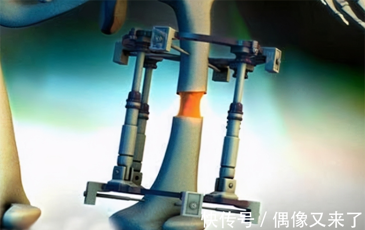 落选|因身高过低自卑,花16万断骨增高7.2厘米的李亚诺,后来怎样了?