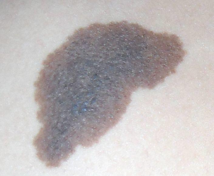 胎记|宝宝身上这3种“印记”,可能藏着疾病,发现了要及时去医院!