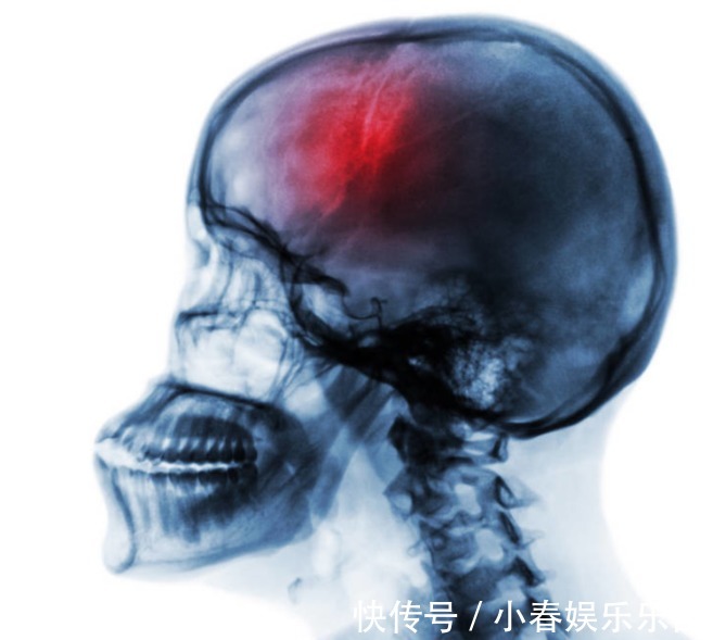 血管|走路能防血栓？医生：记住“三五七”原则，血栓绕道走