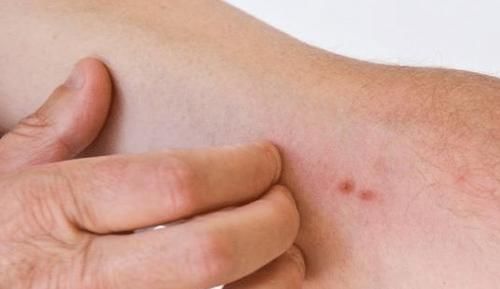 皮肤|42岁男子以为皮肤过敏,却查出肝硬化,医生:身体2处发痒,尽早做检查