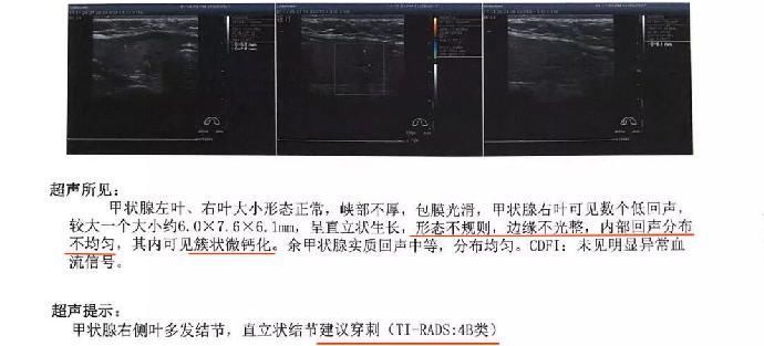 癌症|结节、息肉、囊肿是癌症先兆吗?北肿专家们说出了真相!