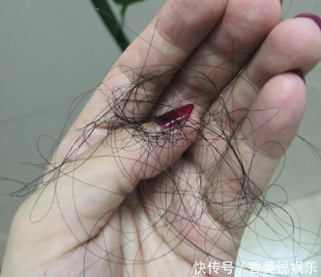 头上出现4个变化,是螨虫已爬入毛囊征兆,很多人不知晓