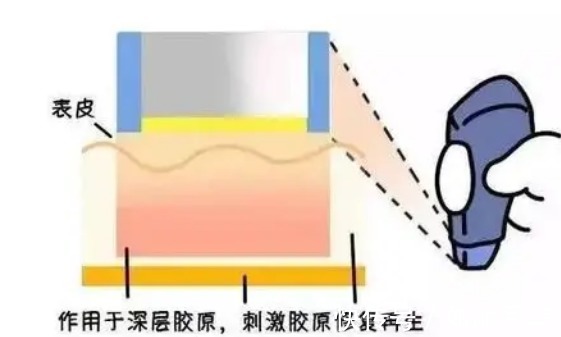 手术 抗衰新星热玛吉原理|热玛吉能维持多久?有没有危险呢?
