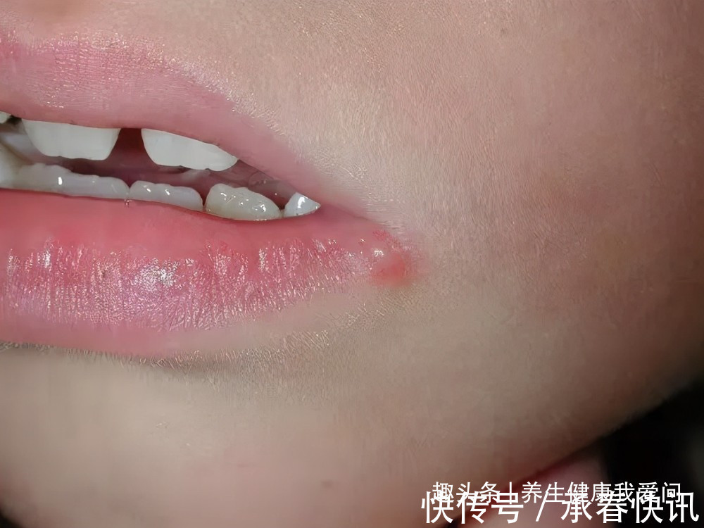 感染|2个月内3名幼童脑死亡！嘴角长这种水泡，真不是“上火”那么简单