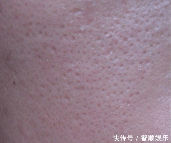 消失|毛孔粗大像火龙果 教你3个天然法, 一周后粗大毛孔消失不见