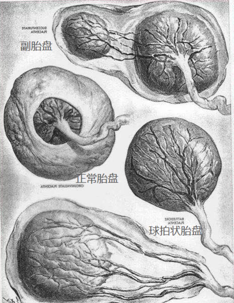 出现帆状胎盘，孕妈们该怎么做？这篇文章告诉你答案