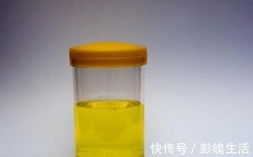 血糖控制|糖尿病患者尿中泡沫多,多是肾不行了?做好2事,也许能改善