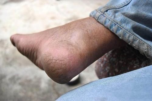 脚跟骨|排名前五的最痛苦的手术是什么?几乎都涉及骨骼,你经历过吗?