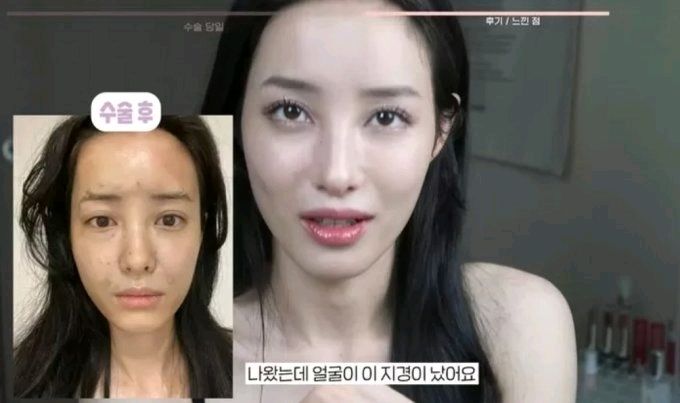 youtuber 韩国离婚女星透露做了隆胸手术和脂肪移植：除了鼻子下巴都整了