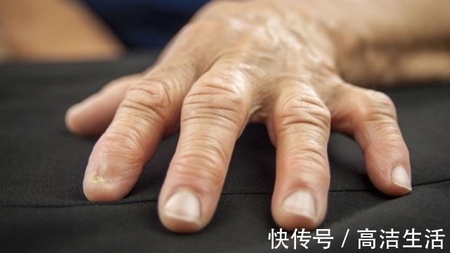 肝炎|指甲是肝脏的晴雨表,出现3种异常,说明可能肝炎又重了