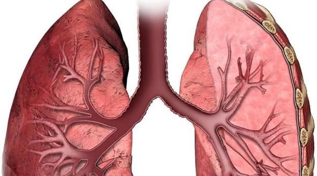 长期抽烟的人,身上2处还没“凸起”,恭喜,肺还算健康!