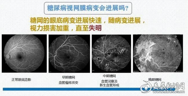 视网膜病变|“糖网”不是“网”，严重可致盲！