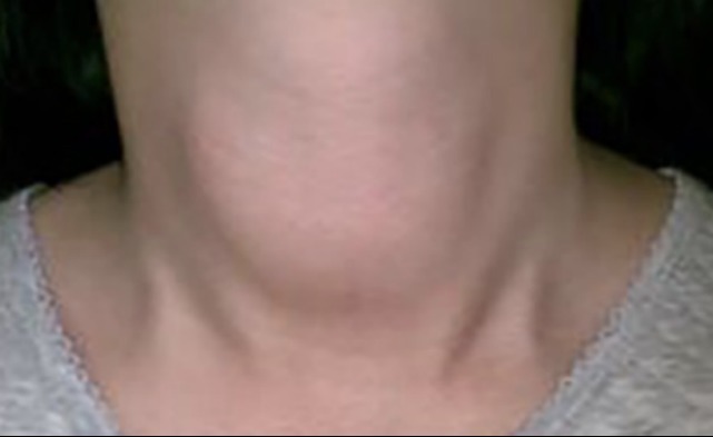 忌口|35岁男子脖子出现“异常”,查出甲状腺结节,医生:这3种食物要忌口