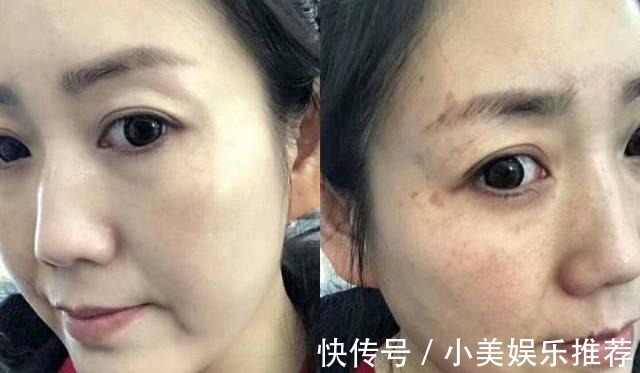 除皱|红霉素软膏加“它”敷脸,一个月淡化色斑又除皱,赶紧去备上一支!