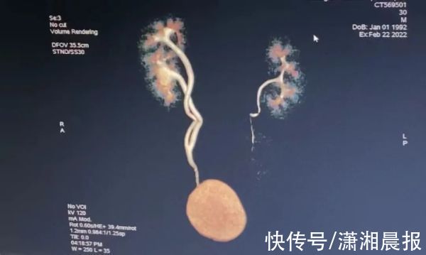 河南|河南一男子长了3个肾，医生：还有长4个的