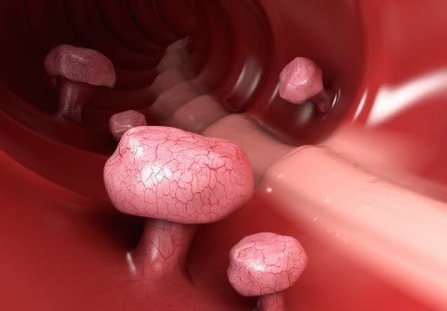 结肠癌|会癌变的肠息肉越来越多,1个习惯是凶手!医生奉劝赶快远离