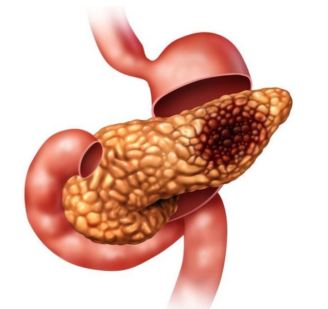 腹痛|胰腺癌出现,身体常发4个警示信号!发现了就是幸事,一秒别拖