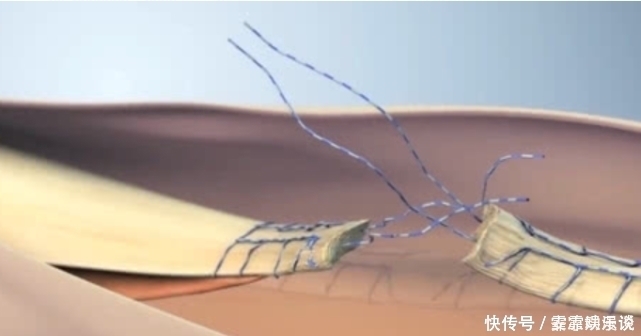 过程|病人断掉的“筋”是怎么接起来的看完动画演示过程,总算明白了