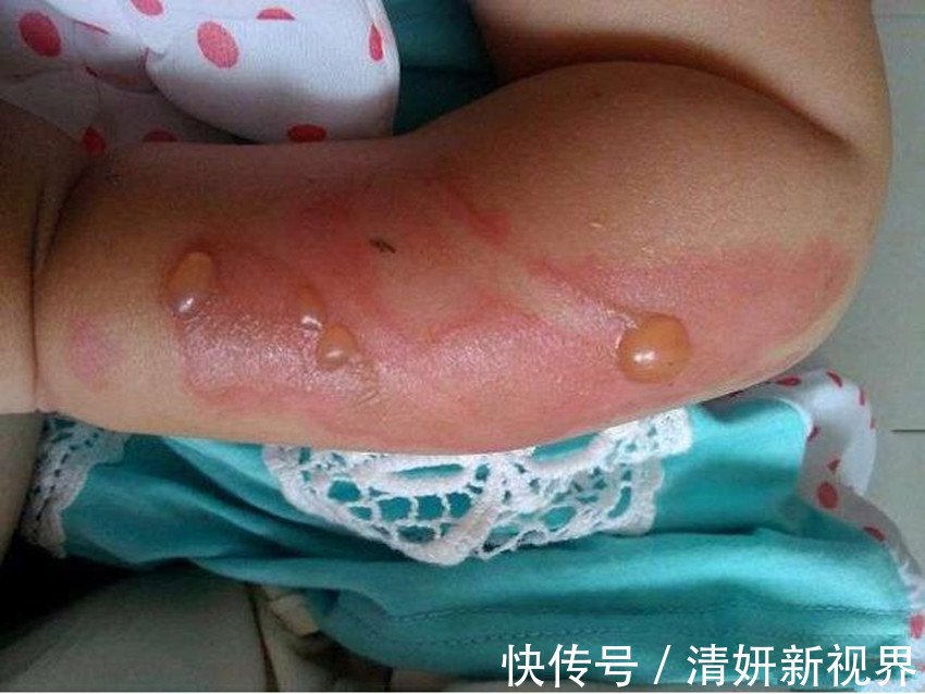 称赞|两岁女儿不小心被开水烫伤,孩子爸的做法令医生称赞简单又专业