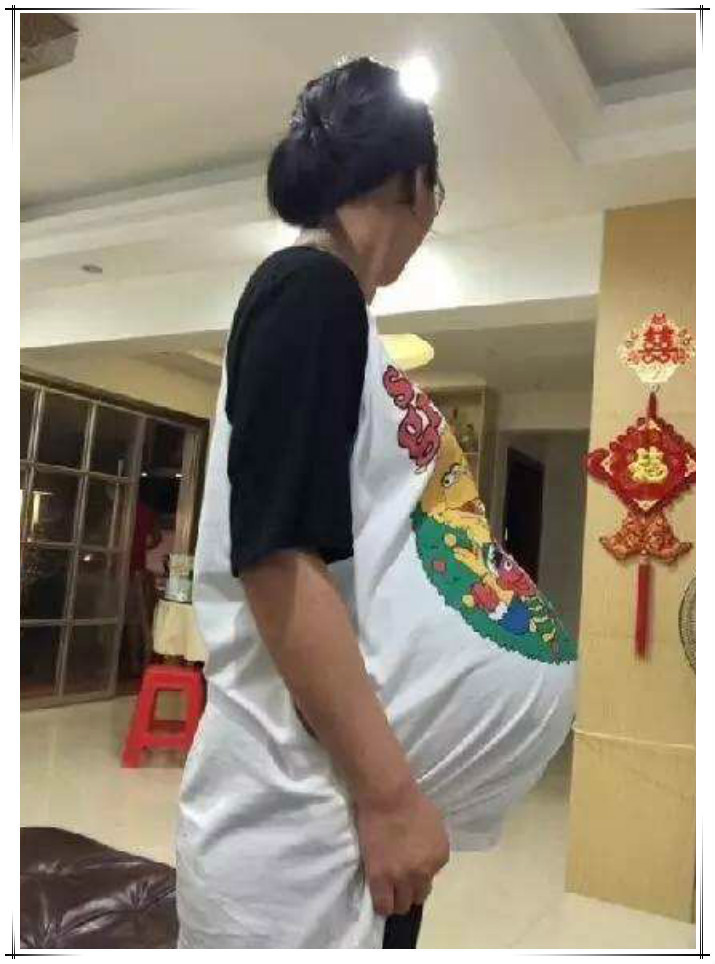 孕妇|孕妇“悬垂肚”走红,网友猜测是“双胞胎”:没见过这样的孕肚
