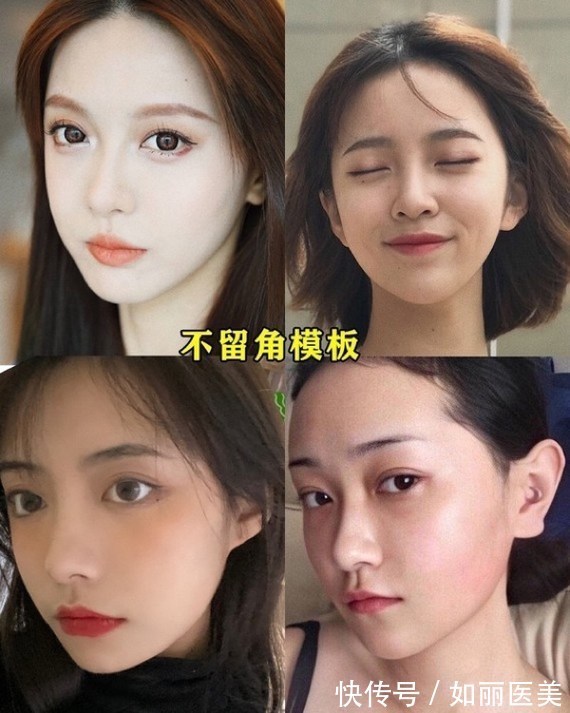 角截骨 下颌角手术的去外板是什么呢?如何判断自己是下颌角肥大还是外板厚呢?