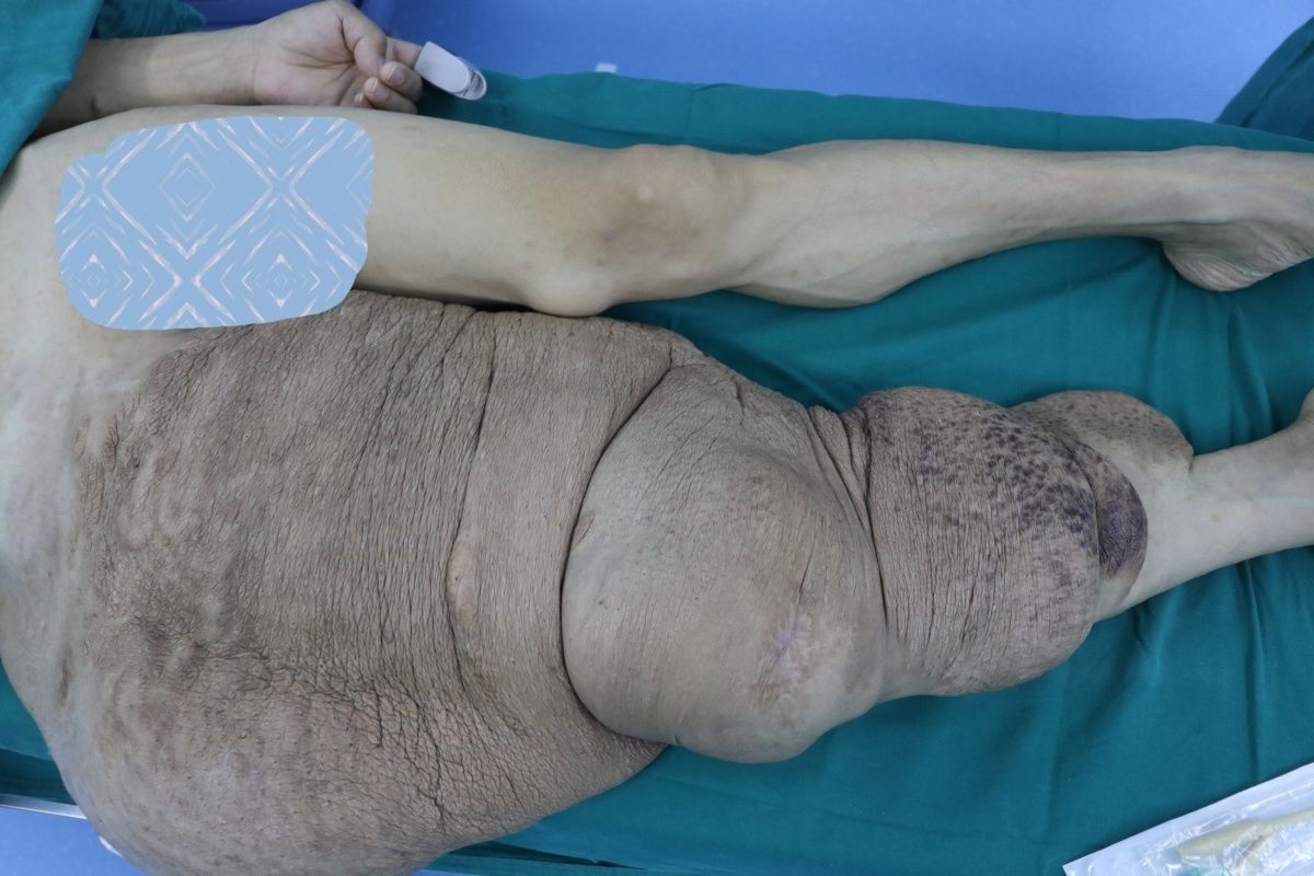 出血|切除病变组织约30斤！历经13个小时，46岁男子成功告别“大象腿”