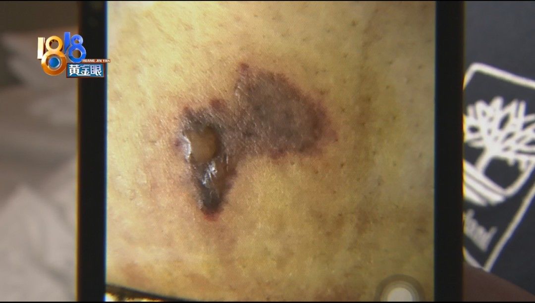 贝瑞佳月子会所杭州临平店|“贝瑞佳”产后修复,“红光特护”被烫伤