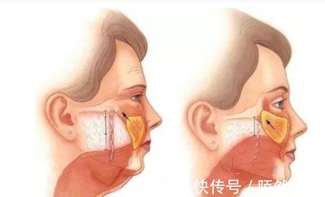 面部轮廓 医美科普|年过40岁的女性,拿什么对抗面部轮廓的整体衰老!