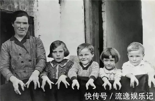 畸形#可恨又可悲的“龙虾手男孩”:畸形跟了他一生,最后死在妻子手里