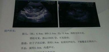 肚子里宝宝|孕检单上若有这3个“特征”,恭喜,或许是“小王子”要来了