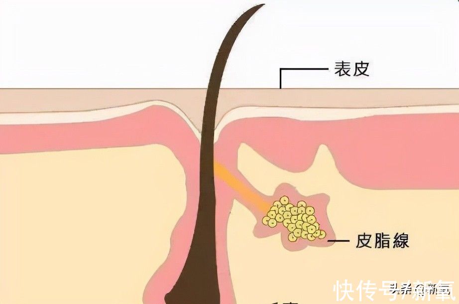 脂肪粒|她鼻背两旁的小疙瘩，到底是啥？