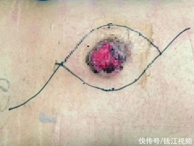 肿块像“韭菜”割了又长！一次摔跤后，背上竟掉出一团肉？