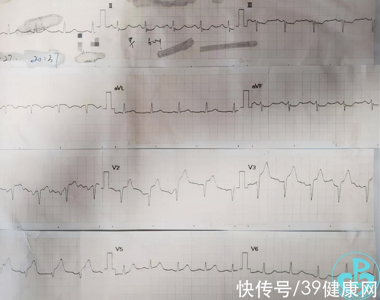 刘鸣|60岁男子心梗，植入支架20分钟后死亡！心脏支架该被淘汰了？