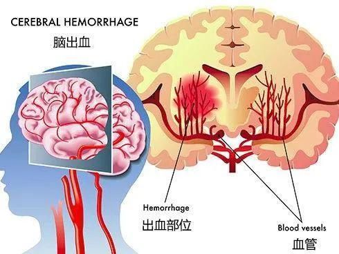 脑出血不是突然到来，手指出现两个表现，已经提前通知你了！